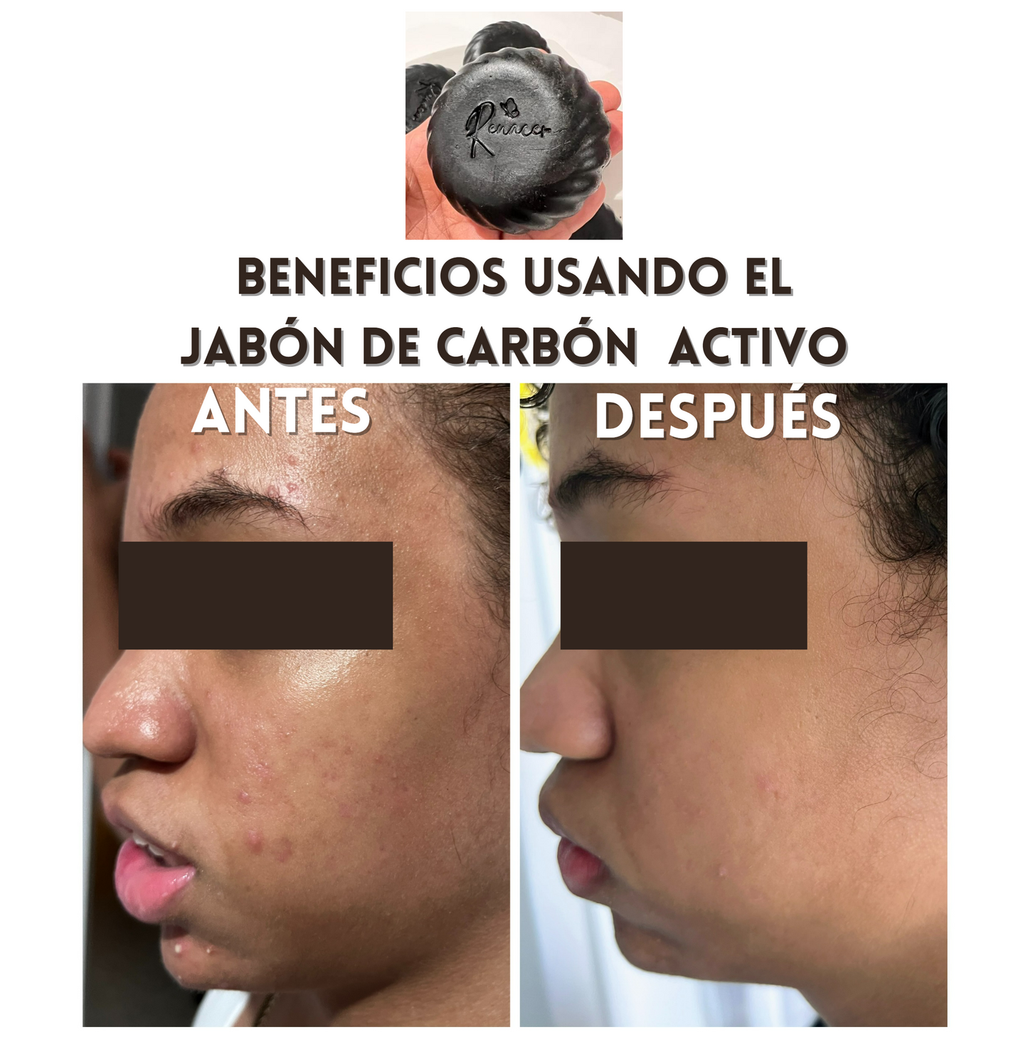 3 Jabones Control de Acné, Cutis graso, carbón Activo