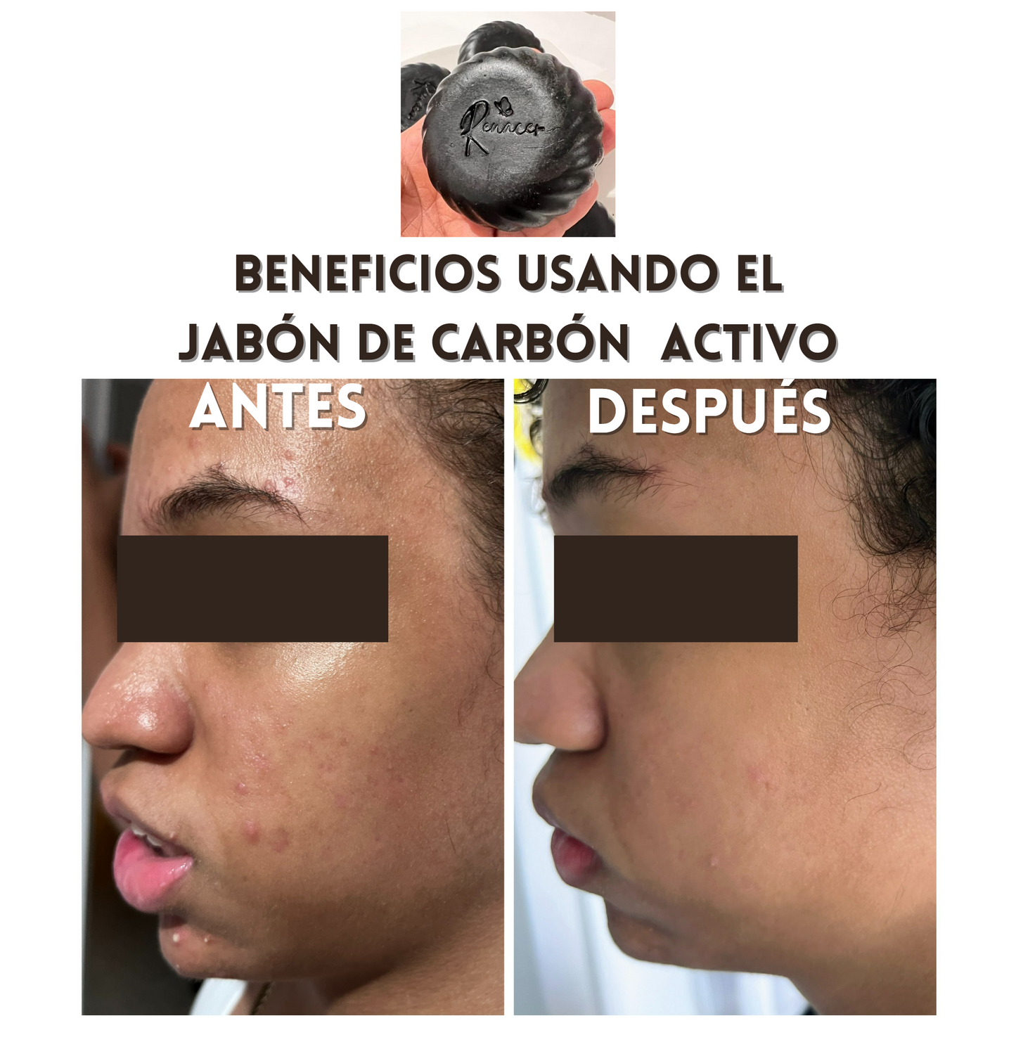 Control de Acné, Cutis graso, Jabón de carbón Activo